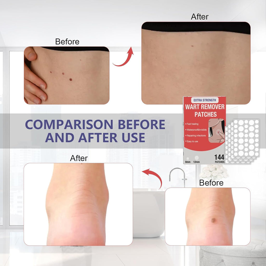 HSFIYAKJ Hydrocolloid Patches, 144 Pcs